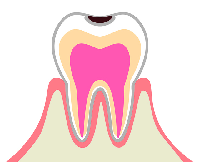 C1 エナメル質のムシ歯