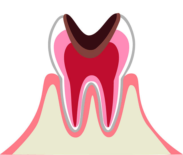 C3 歯の神経に達したムシ歯