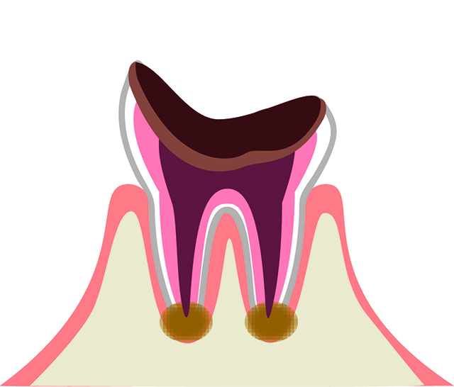 C4 歯の根っこだけになったムシ歯